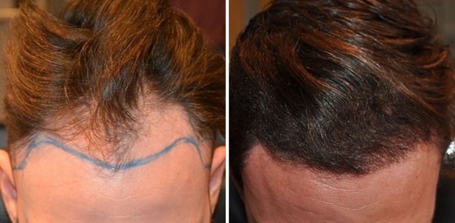 Wimpole patient's mid scalp before and 7 months after 1600 grafts FUE hair transplant