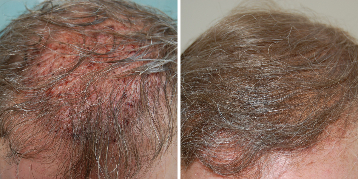 before and after hair transplant hair wash