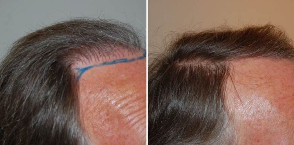Before and 6 months after a 1200 graft corrective hair transplant.