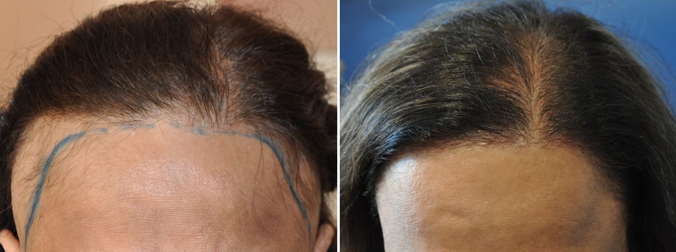 Before and after a 2000 graft female hair transplant