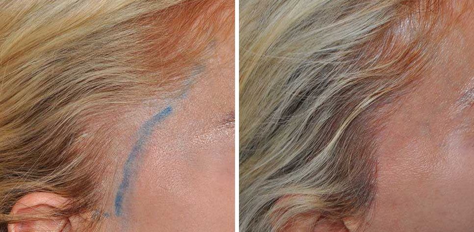 Before and after a 400 graft female hair transplant