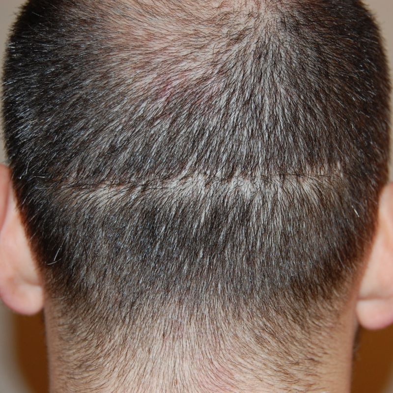 FUT scar from an earlier surgery