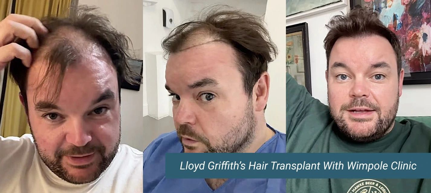 Llyod Griffith hair transplant