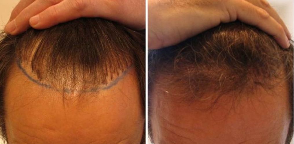 Patient before and after hair transplant repair