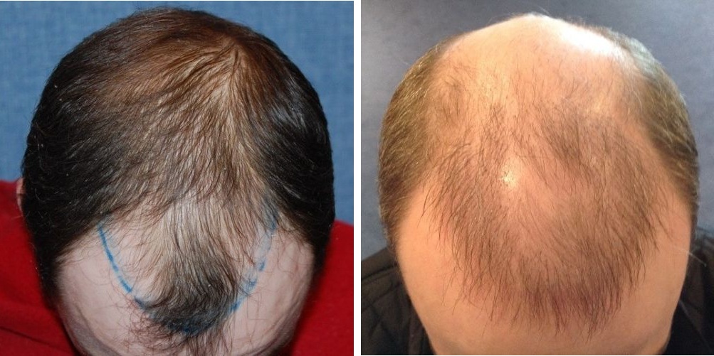 Patient before hair transplant (left) and Patient 10 years after hair transplant (right)
