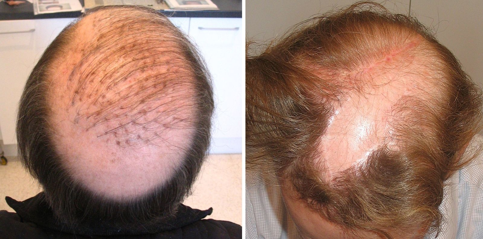 Patient with hair plugs on the left, patient hairline after a Juri flap procedure on the right