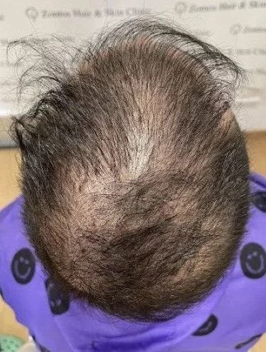 Patient with overharvested hair after 2 bad hair transplants