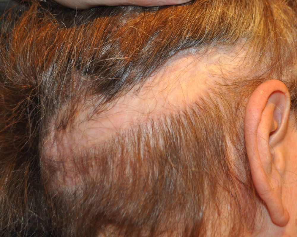 Patient's donor area after 2 massive FUT surgeries