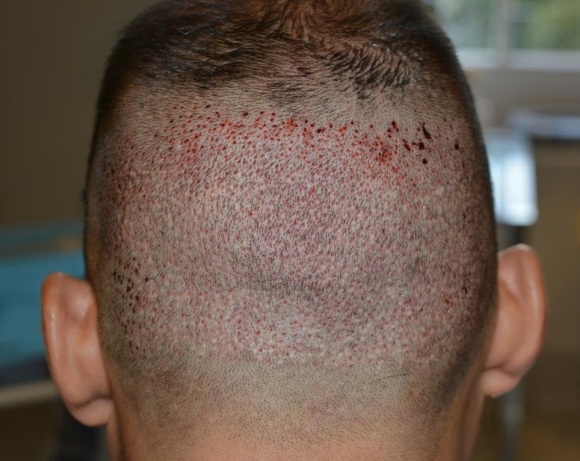 Patient's donor area immediately after FUE hair transplant