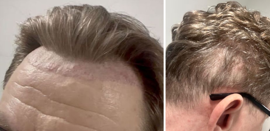 Hair Transplant Horror Stories And How To Avoid Them, Wimpole Clinic