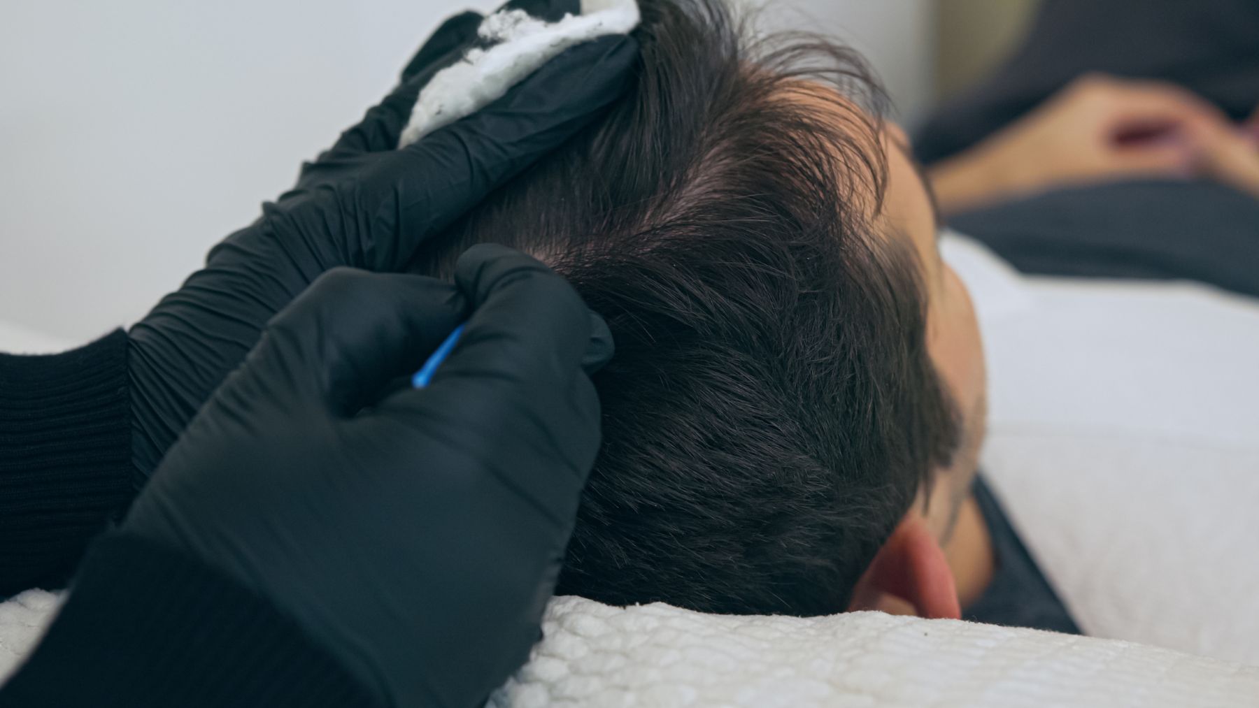 Scalp micropigmentation for women