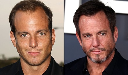 Will Arnett Hair Transplant