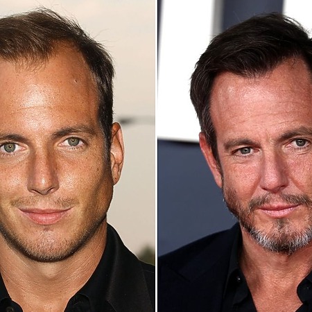 Will Arnett hair transplant
