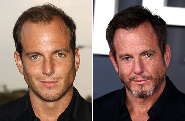 Will Arnett hair transplant