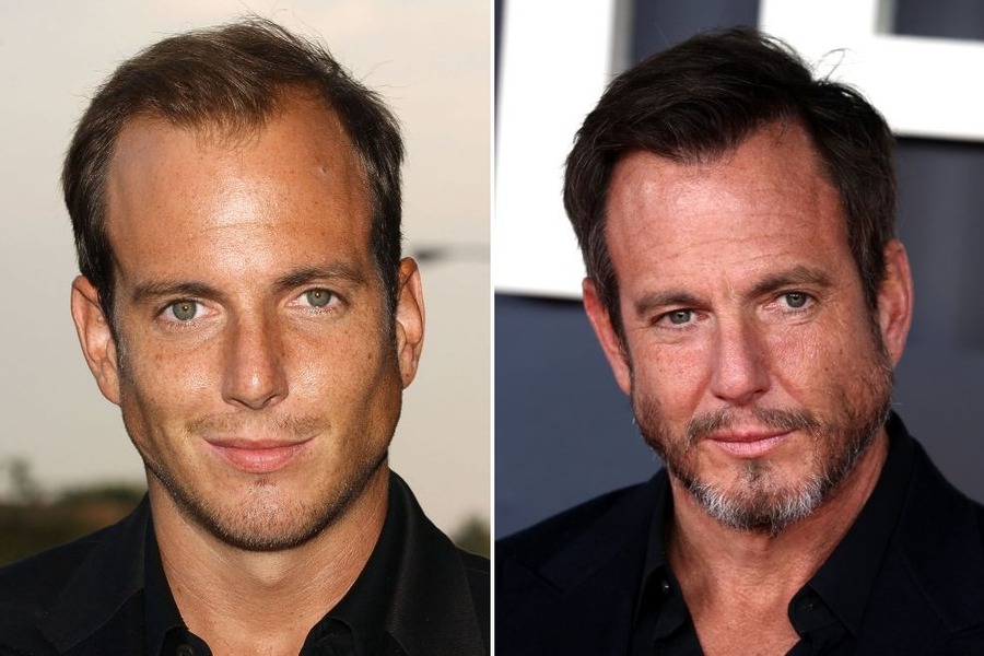 Will Arnett Hair Transplant