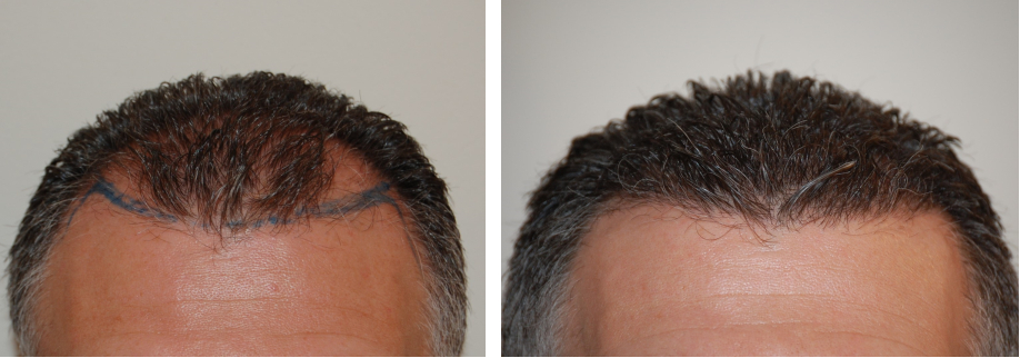 Did Paul Antoine From MAFS Really Have a Hair Transplant?, Wimpole Clinic