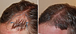 Hair Transplant