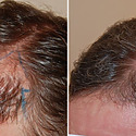 Hair Transplant Repair: Are You A Candidate?
