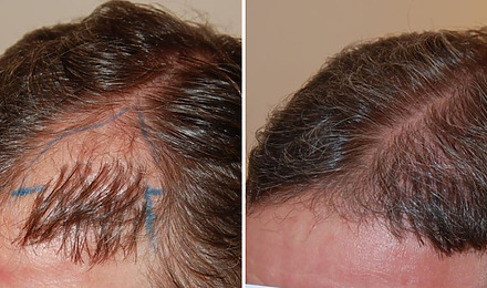 Hair Transplant Repair Featured Image
