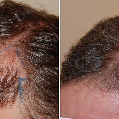 hair transplant repair featured image