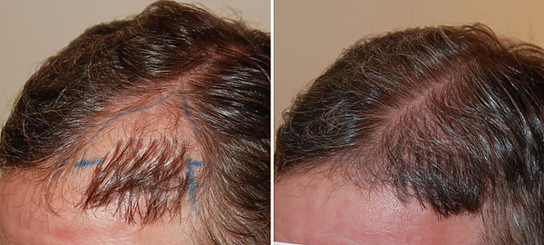 hair transplant repair featured image