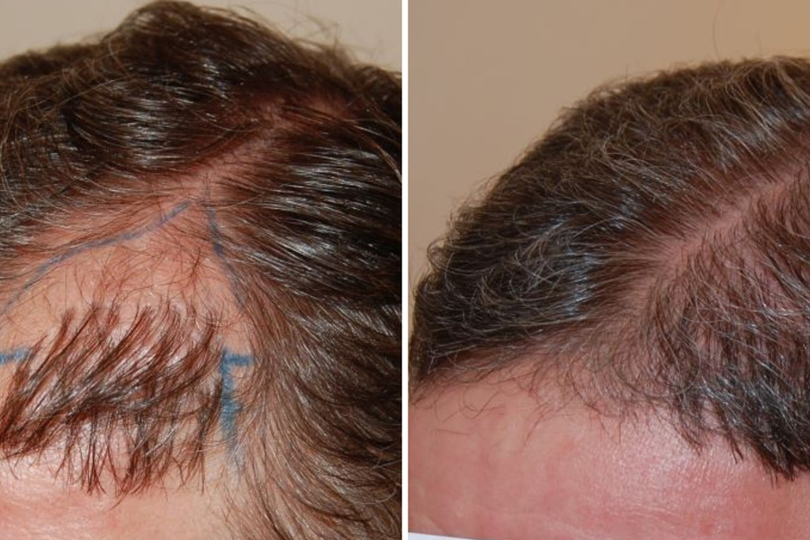 Hair Transplant Repair Featured Image