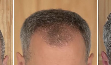 How Long Does It Take For Hair To Grow Back