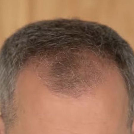 how long does it take for hair to grow back