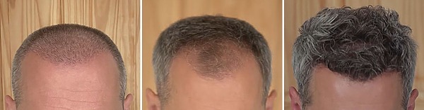 how long does it take for hair to grow back