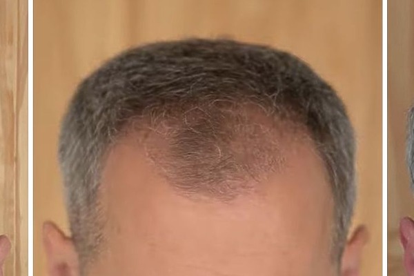 How Long Does It Take For Hair To Grow Back