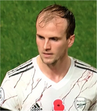 Rob Holding hair transplant before and after