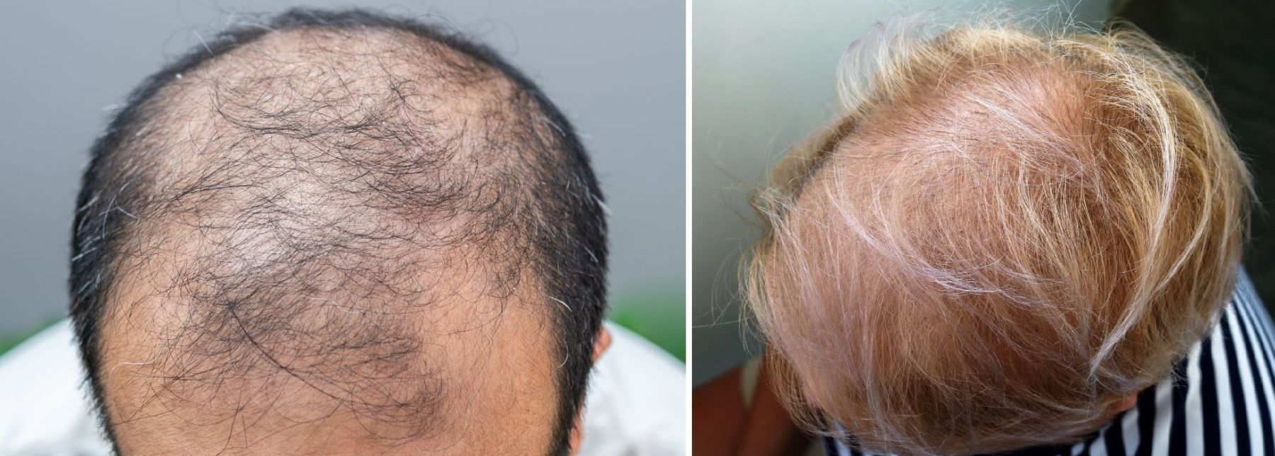 male and female pattern hair loss