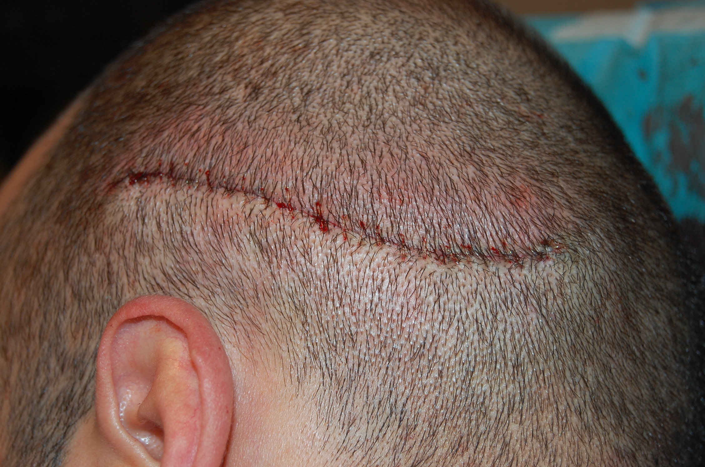 stitched up FUT strip