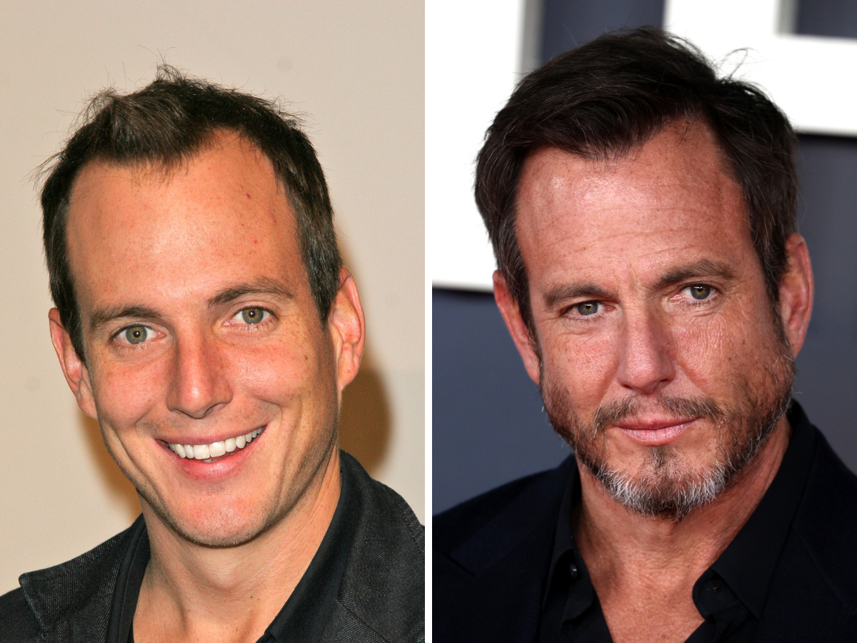 will arnett's hairline