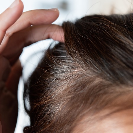 does stress cause grey hair