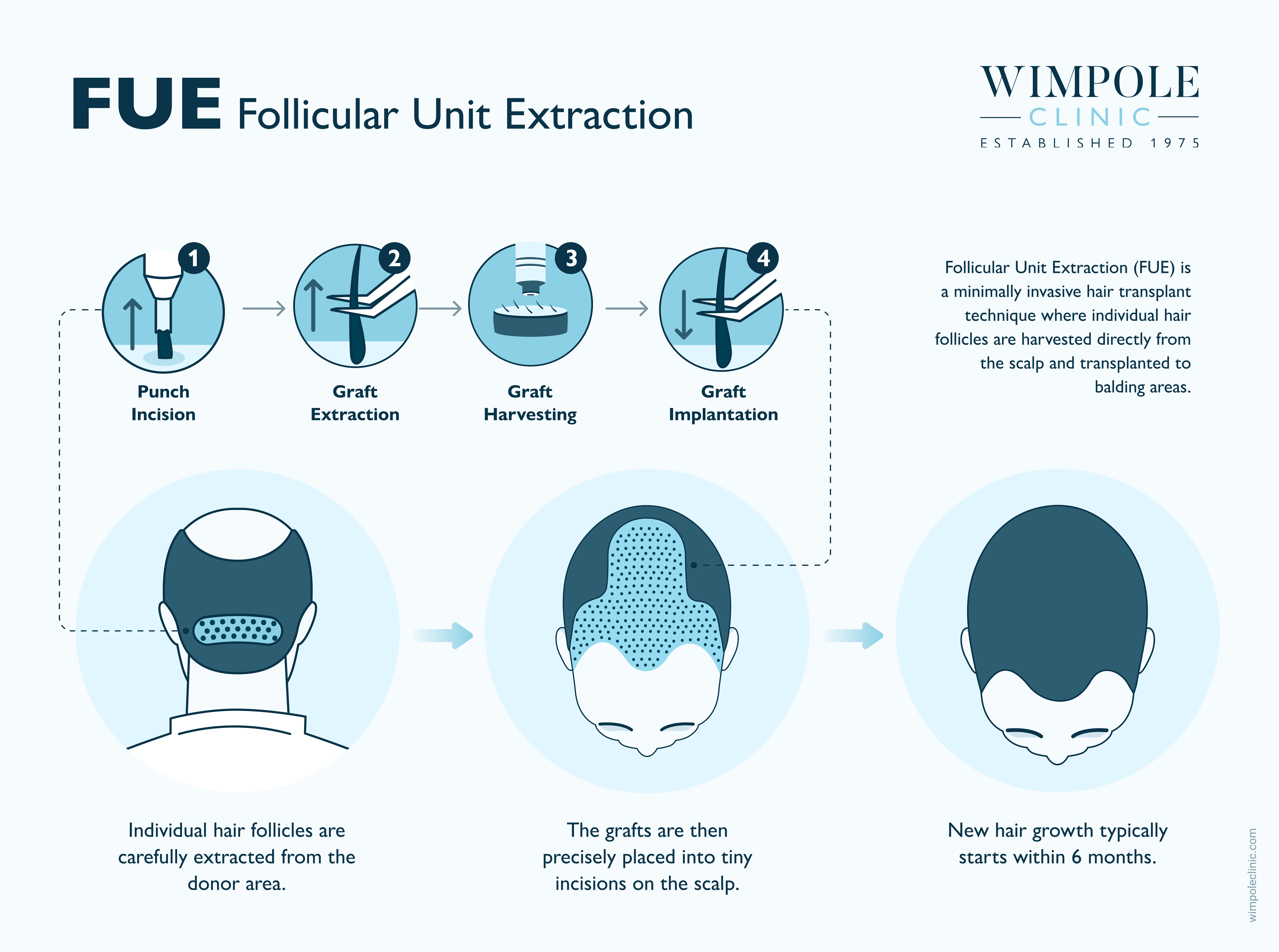 infographic about FUE Follicular Unit Extraction