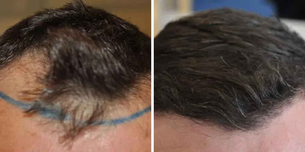 A Wimpole Clinic 1200 graft hair transplant before and 7 months after surgery.