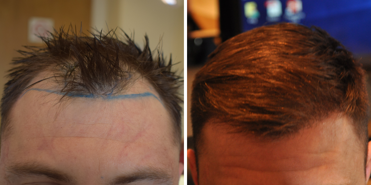 Before and 6 months after a 1900 graft FUE hair transplant performed at the Wimpole Clinic.