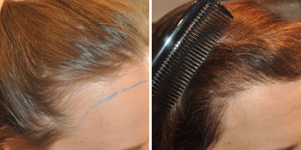 before and after hairline lowering procedure