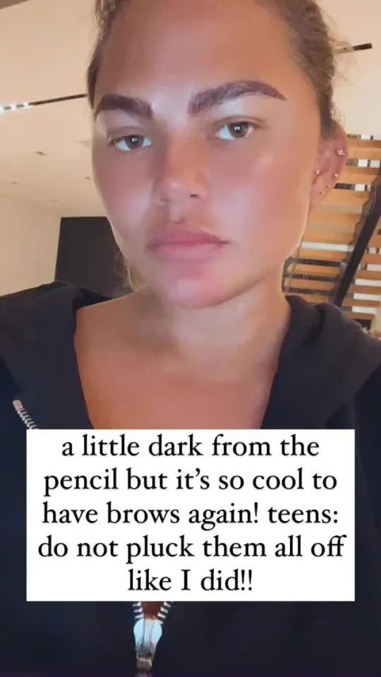 Chrissy Teigen&rsquo;s Eyebrow Transplant: Overplucked Brow Transformation, Wimpole Clinic
