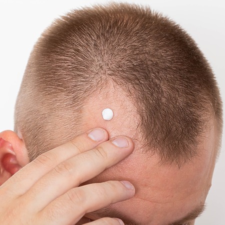 clascoterone hair loss