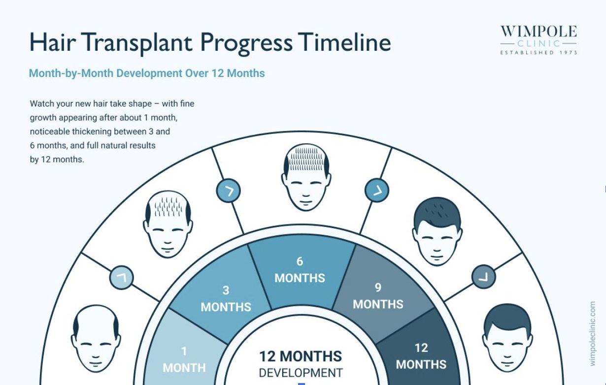 MoM hair transplant progress timeline