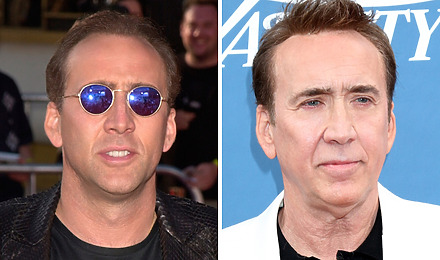 Nicolas Cage Hair Transplant