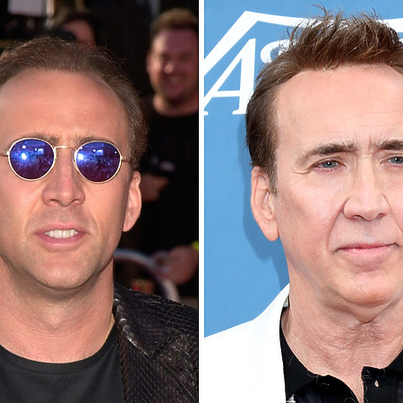 nicolas cage hair transplant