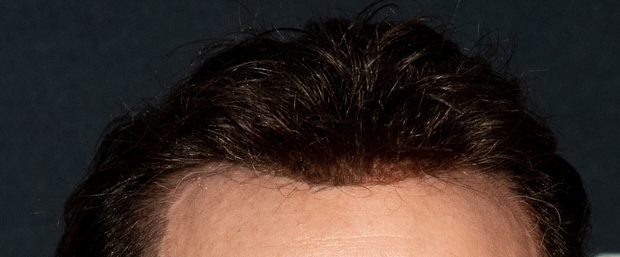 Close up of Nicolas Cage&rsquo;s hairline (2022)