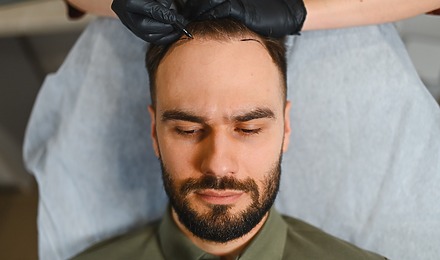 Scalp Reduction Surgery Featured Image