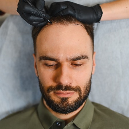 scalp reduction surgery featured image