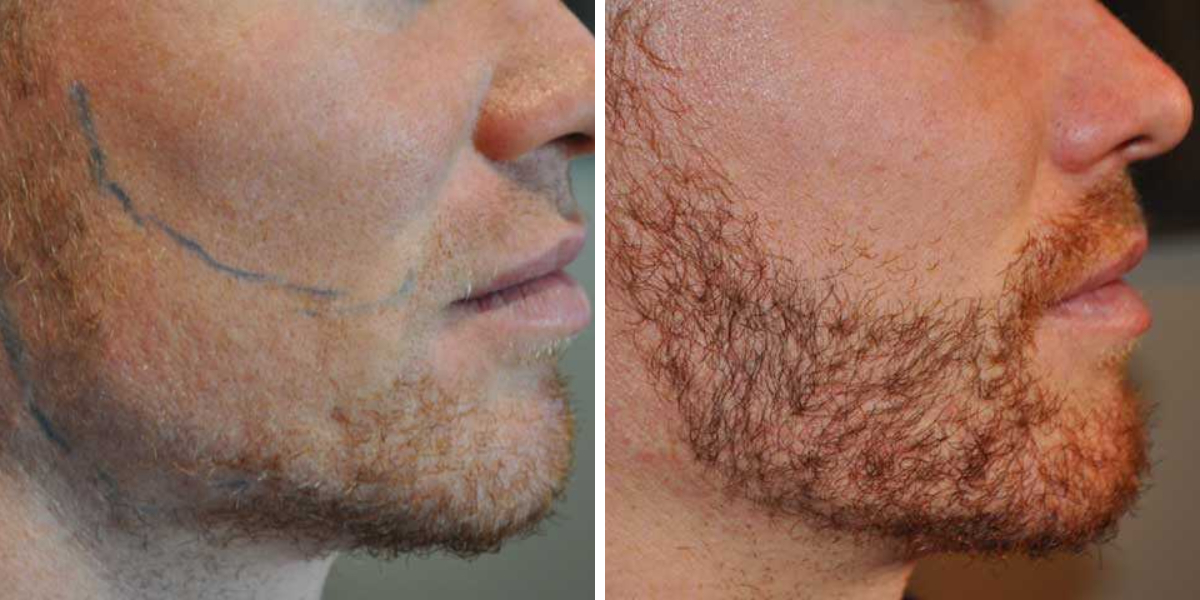 before and after beard transplant at the wimpole clinic