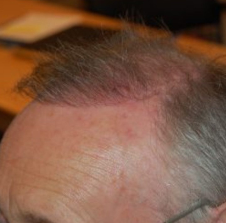 Hair Transplant After 3 Months Photos, Results, Side Effects