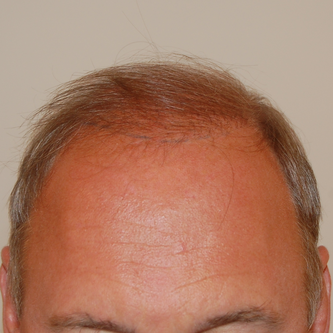 1000 Graft Hair Transplant: Coverage, Costs, Results